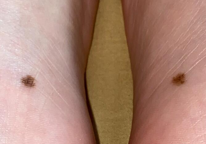 風(fēng)水先生分享足底痣相解析